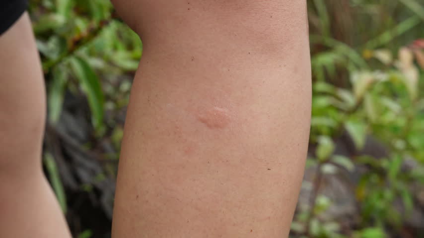 Close up of applying soothing ointment cream to treat itchy black fly insect bites on lower leg outdoors