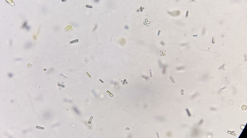 Calcium oxalate and monohydrate under microscope. Urine microscopy showing Calcium oxalate and monohydrate.