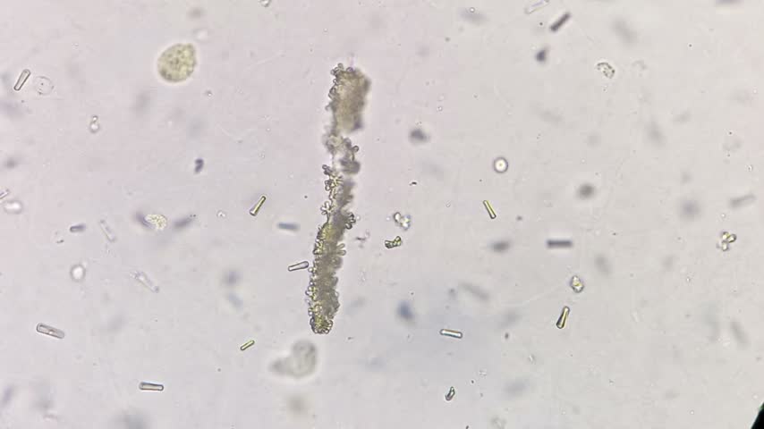 Granular cast from a urine sediment sample evaluated under brightfield microscopy. Urine microscopy showing Calcium oxalate and monohydrate.