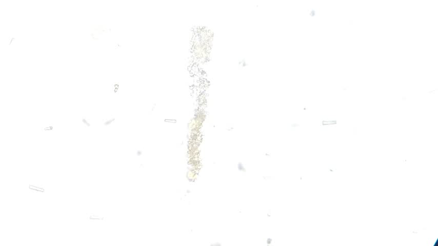 Granular cast from a urine sediment sample evaluated under brightfield microscopy. Urine microscopy showing Calcium oxalate and monohydrate.