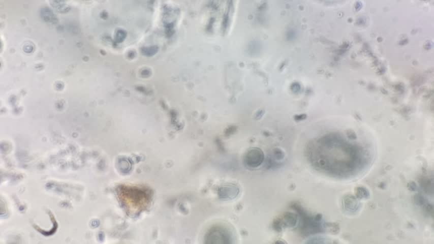 Yeast candida and monohydrate under microscope. Urine microscopy showing Calcium oxalate and monohydrate.