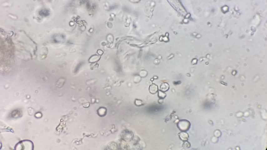 Yeast candida and monohydrate under microscope. Urine microscopy showing Calcium oxalate and monohydrate.