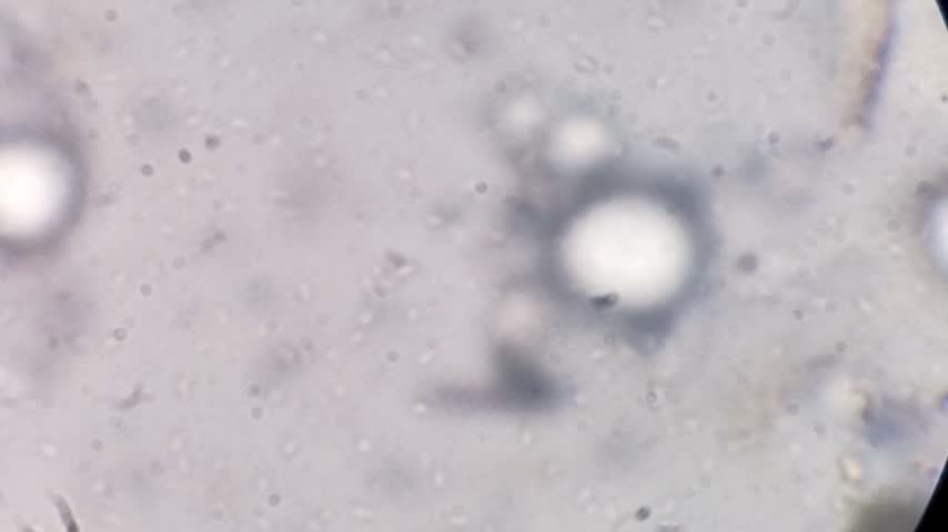 Yeast candida and monohydrate under microscope. Urine microscopy showing Calcium oxalate and monohydrate.