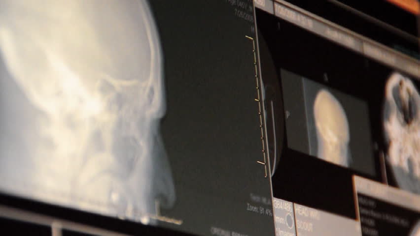 A doctor examines a head MRI scan on a computer screen.