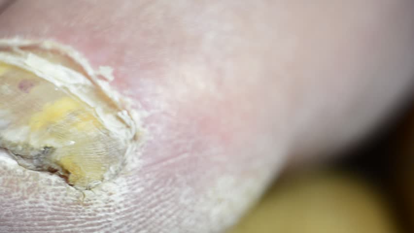 Fungi Toes - Stock Video. Toenails with common fungal infection. Shot with macro