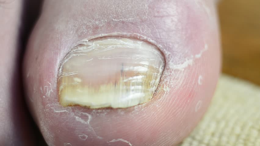 Nail fungus closeup - Stock Video. Close up of a fingernail affected by