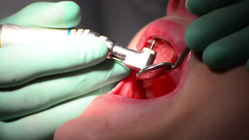 child at dental checkup and caries cleaning with drill