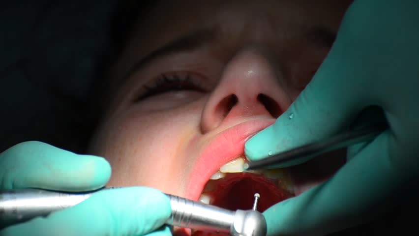 Young girl having her teeth fixed at the dentist's. Caries cleanup and