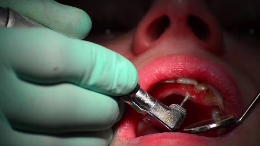 dental drill is dril caries from teeth, close up