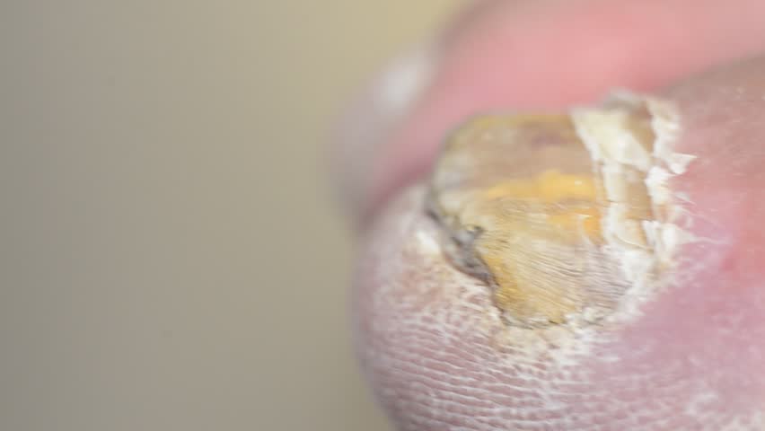 Toenails with common fungal infection. Shot with macro lens and shallow depth of