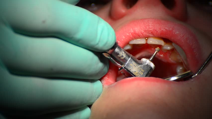 Young girl having her teeth cleaned from caries at the dentist's, close up
