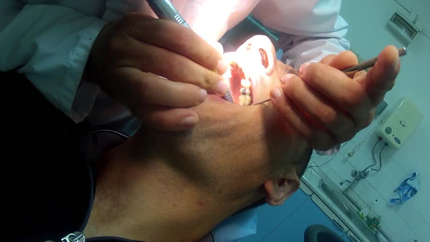 dental drill prepares tooth for filling. doctor POV