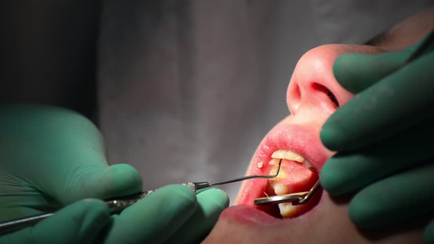dentist check gum for gingivitis disease