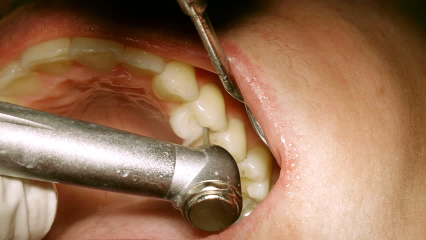Dentist Drill Teeth  . The Perfect Teeth Drill Dentist Animated Gif For Your Conversation.