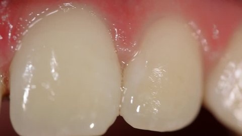 Closeup on human dentition (teeth) 