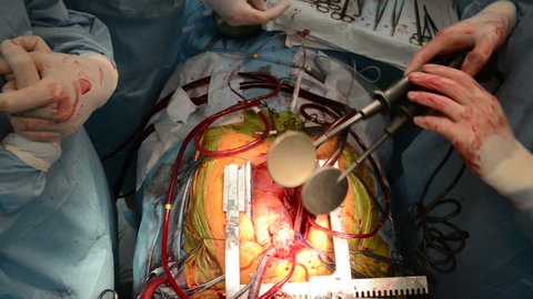 hand of surgeon perform defibrillation to the heart during cardiac transplantation operation on a patient at surgery clinic