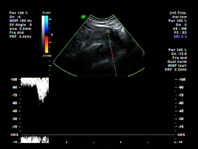 Baby ultrasound heart beat check