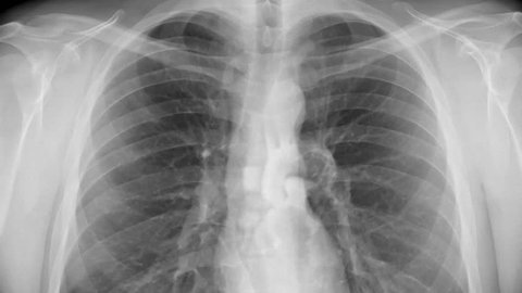 Chest x-ray. Animation of breathing chest and beating heart.