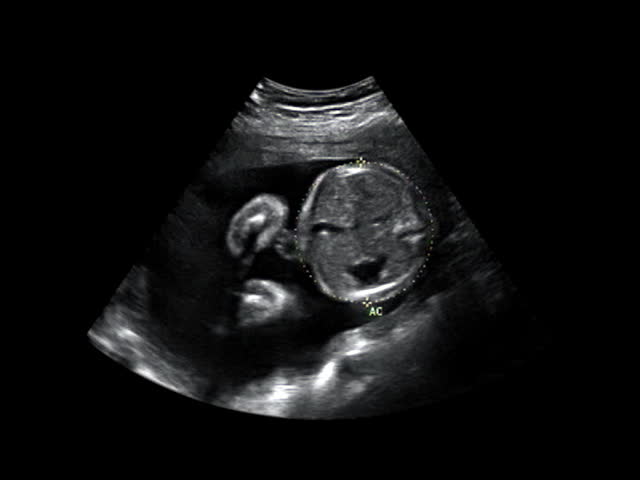 Baby ultrasound head measuring