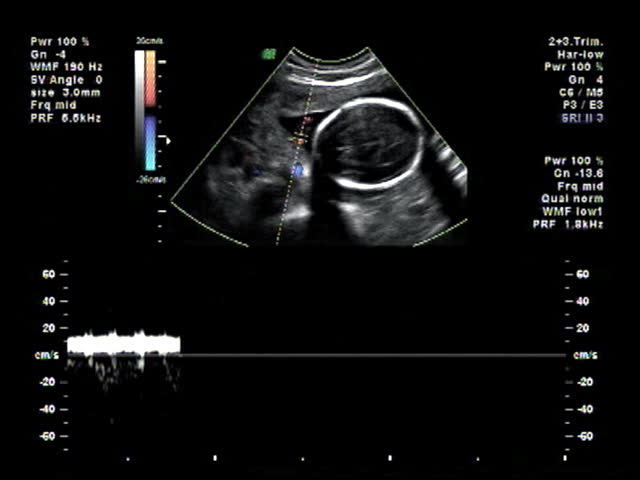 Baby ultrasound heart beat