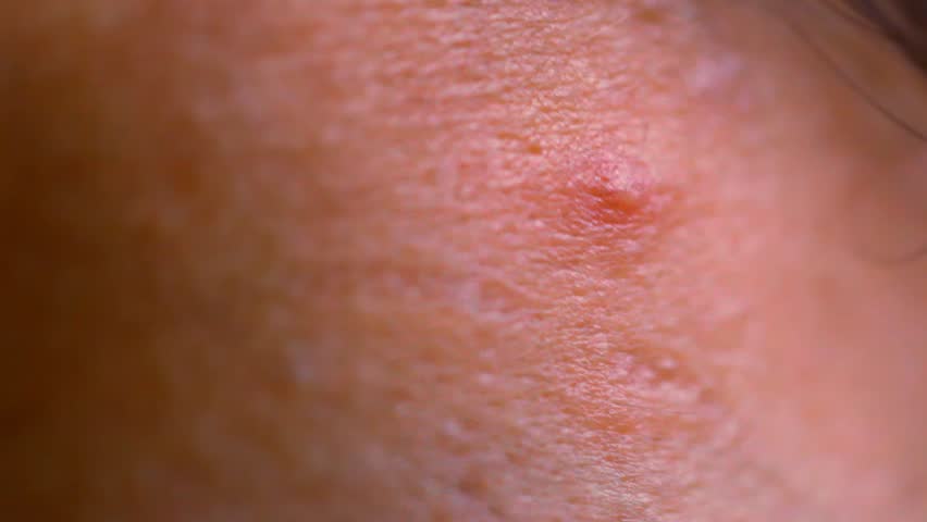 pimple on the skin close-up. Macro video Royalty-Free Stock Footage #6761002