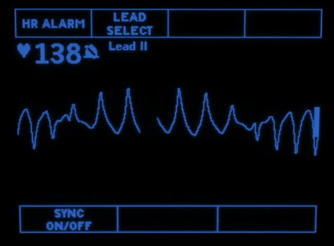 A simulated monitor showing the Torsades de Pointes rhythm.