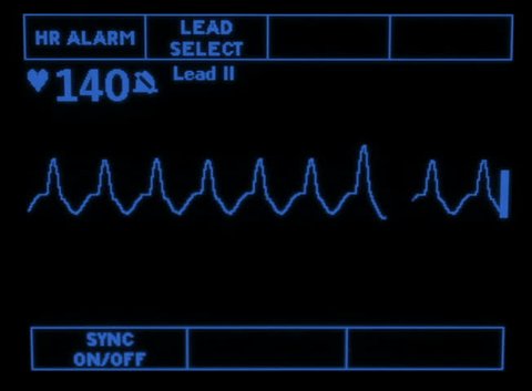 A simulated monitor showing the accelerated idioventricular rhythm.