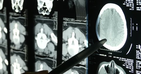 Doctors study head skull brain X-ray film for analysis.health medical hospital. gh2_08194_4k