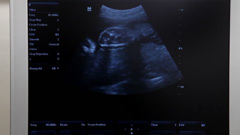 Ultrasound of human fetus at 17 weeks. Hands and head are visible.