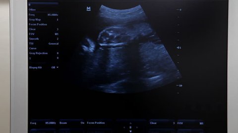 A 4d Ultrasound Of A Video De Stock 100 Libre De Droit Shutterstock