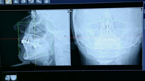 X-ray of teeth on a computer screen