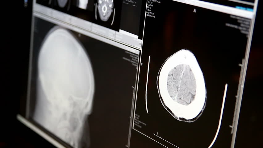 A doctor examines a head MRI scan on a computer screen.