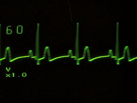 EKG screen close-up flat line - NTSC