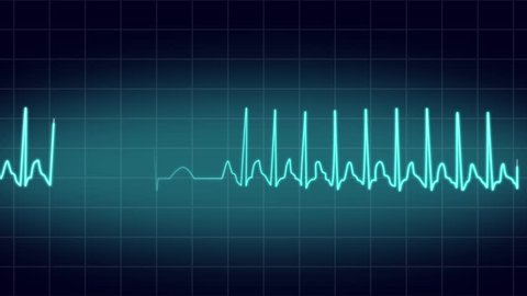 Animated EKG Display