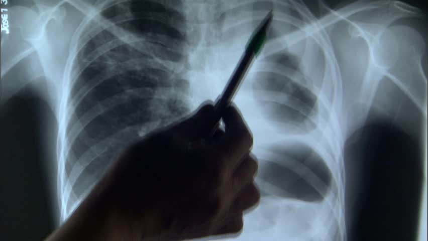Doctor pointing at chest x-ray at tuberculosis clinic in Lima, Peru. | Shutterstock HD Video #7752943