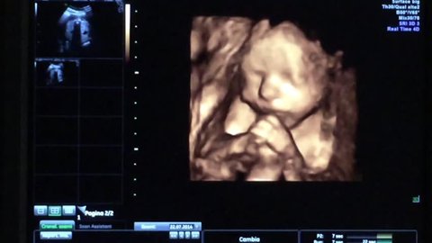 A 4D ultrasound of a baby boy at 25 weeks gestation
