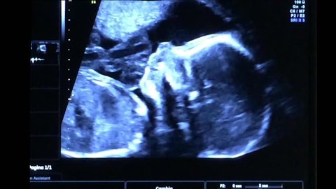 Baby yawning during Ultrasound scan (6 months-21st weeks) with heartbeat sound.
Baby boy ultrasound of 21st weeks with yawn and heartbeat sound