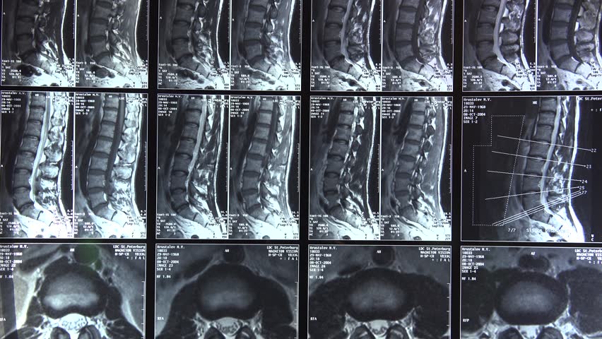 Кт пояснично крестцового отдела. СКТ грудного отдела позвоночника. РКТ снимок позвоночника. МСКТ поясничного отдела позвоночника. Спиральная компьютерная томография (СКТ) позвоночника.