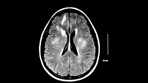 An abnormal MRI scan of the brain depicting demylenating lesions often associated with multiple sclerois